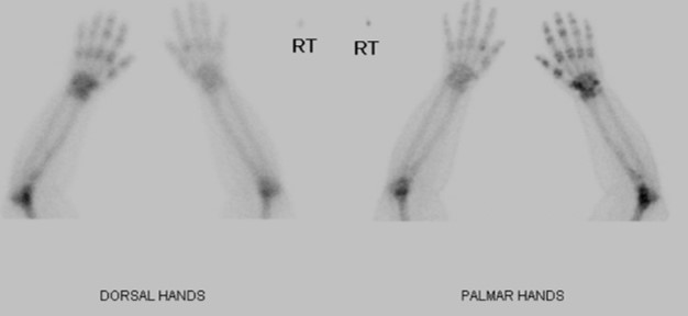 RDS hands | Titan Radiology